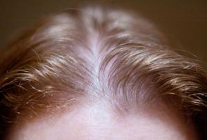 کشف بیماری‌های پنهان از موهای سر